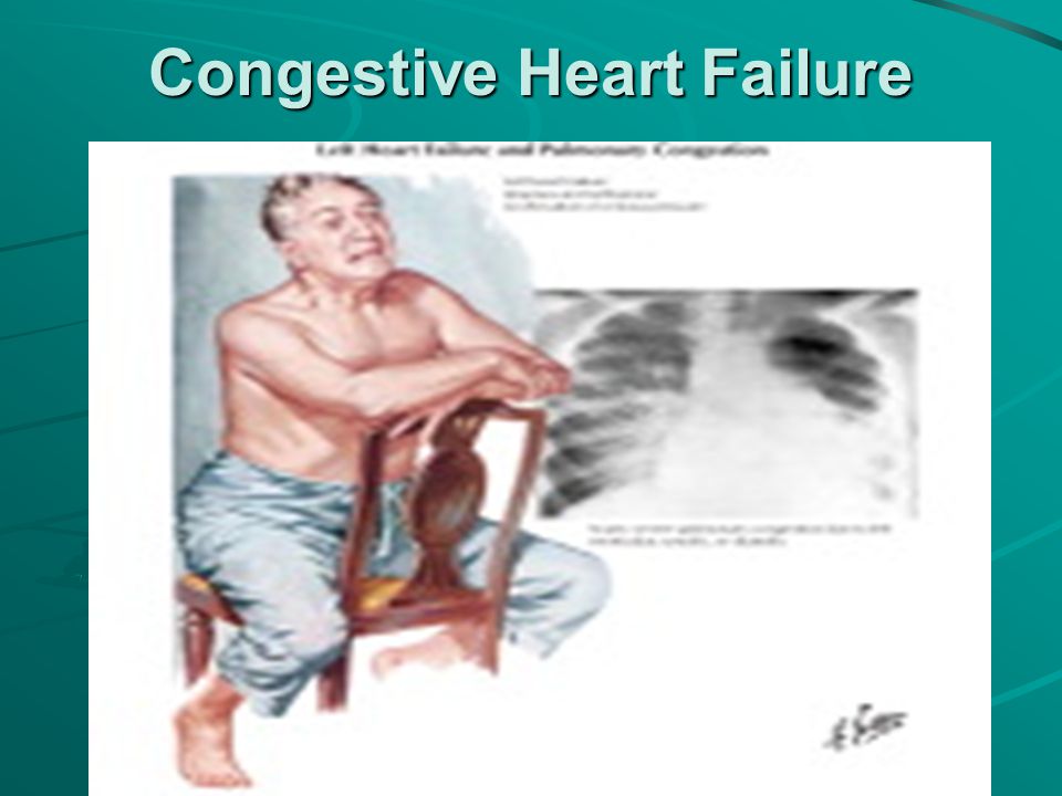 Congestive heart failure case study nursing